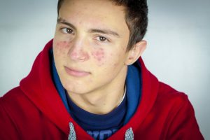 Acne Care Tips For Teenage Boys